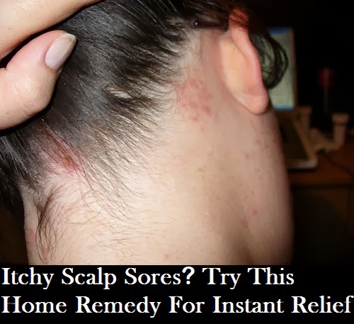 What causes scalp sores?